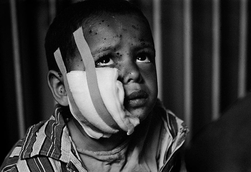 Shrapnel wounds on the face of a frightened boy in a ward at Sarajevo hospital during the siege in 1992.