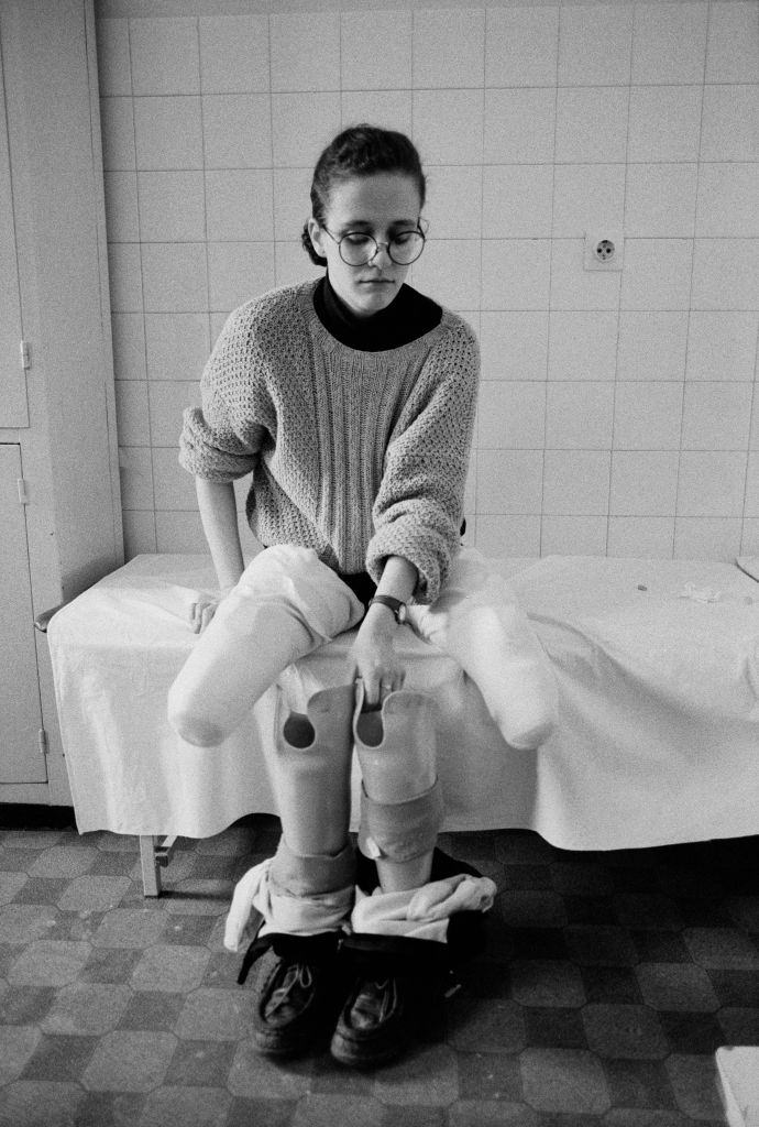 A girl who lost her both legs in the hospital during the Bosnian War, 1994.