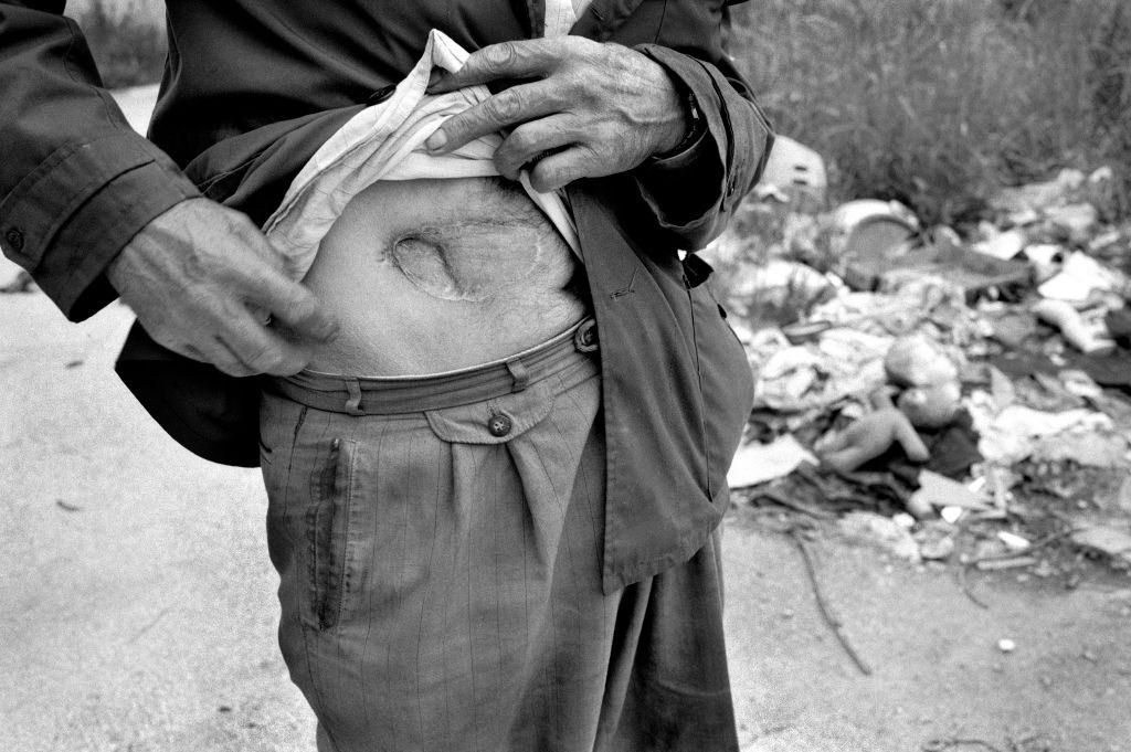 An elderly man displays a scar from a stomach wound caused by shrapnel from a mortar shell, 1966.