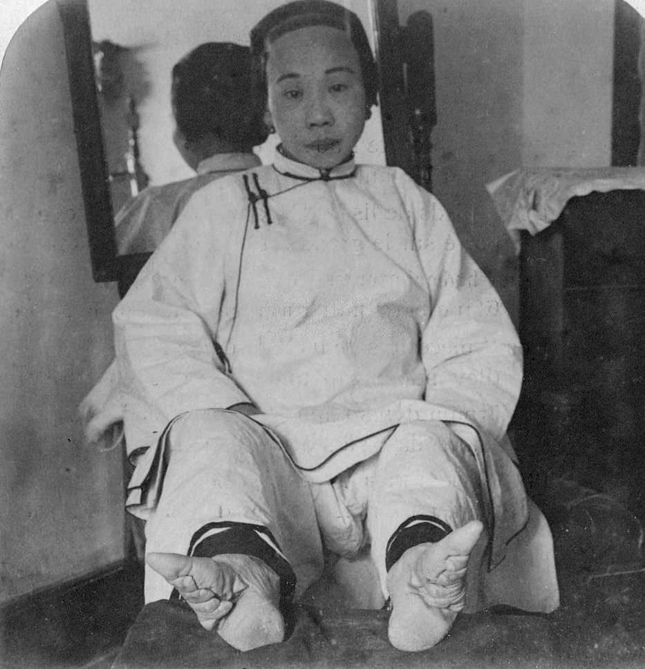 A high caste lady's dainty 'lily feet', showing method of deformity', China, 1900.