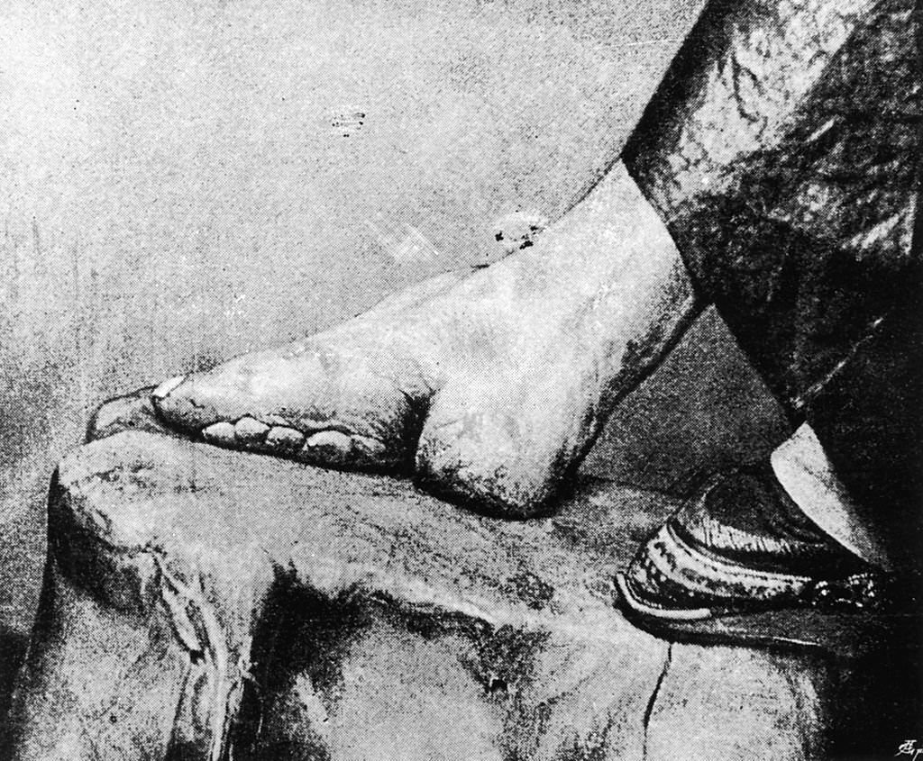 A close-up of the feet of an aristocratic Chinese woman, deformed by binding.