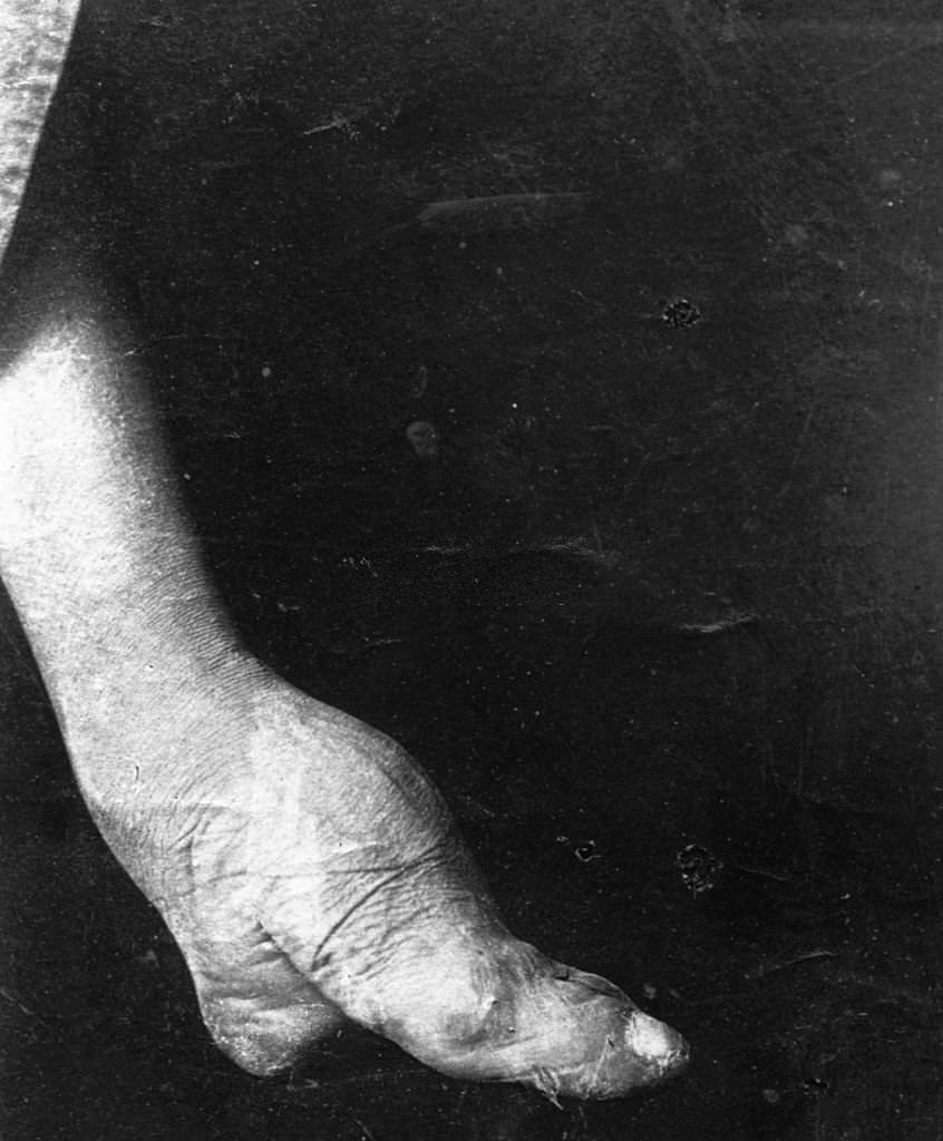 The atrocious pain of Chinese foot binding usually starts around age four for women and requires wrapping bandages tightly around the foot.
