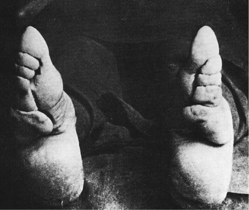 Bound Feet: Horrible Body Modification that Chinese Women Practiced for One Thousand years