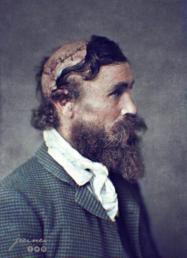 Robert McGee was left permanently scarred after surviving a scalping at the hands of the Sioux tribe in 1864, when he was just a 13-year-old orphan.