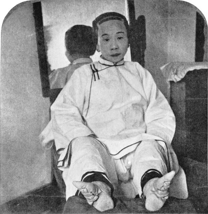 A Chinese woman whose feet were bound in the late 1800s.While foot binding mostly fell out of favor by the 1930s.