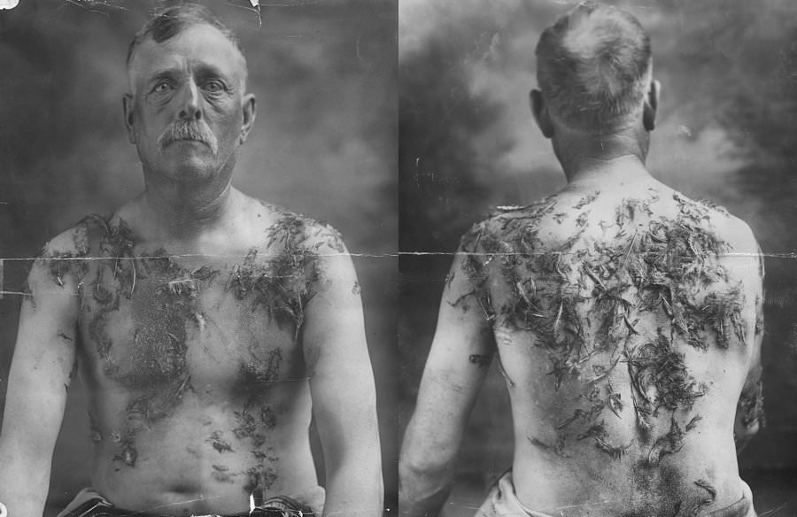 German-American farmer John Meints displays the ill effects of the attack he suffered on August 19, 1918,