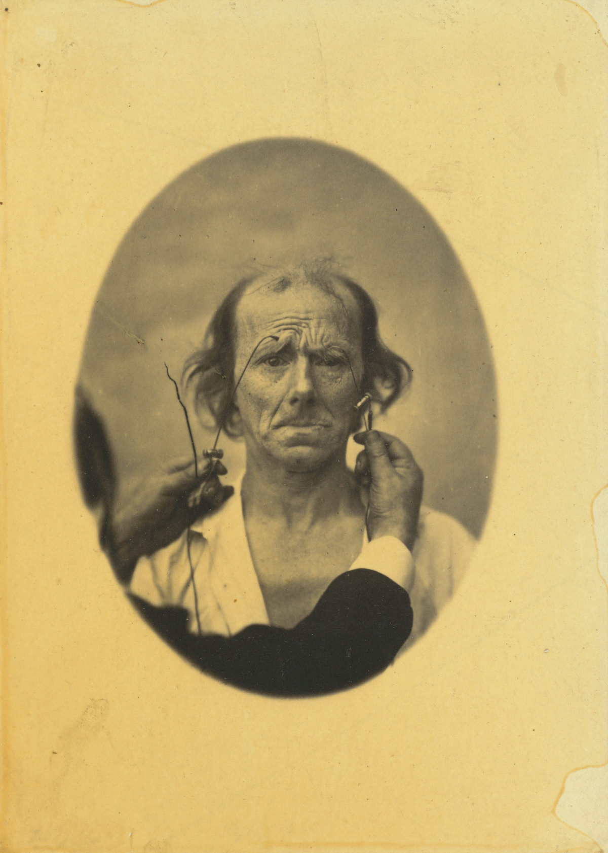 Guillaume-Benjamin-Amant Duchenne (de Boulogne), Dissatisfaction, somber thoughts (left); Reflection (right), 1854-1856,