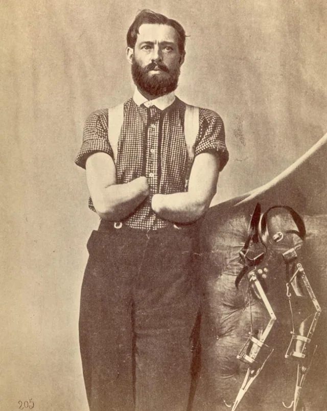 Pvt. Samuel H. Decker, Company I, 4th US artillery. Double amputation of the forearms for injury caused by the premature explosion of a gun on 8 October 1862, at the Battle of Perryville, KY. Shown with self-designed prosthetics.