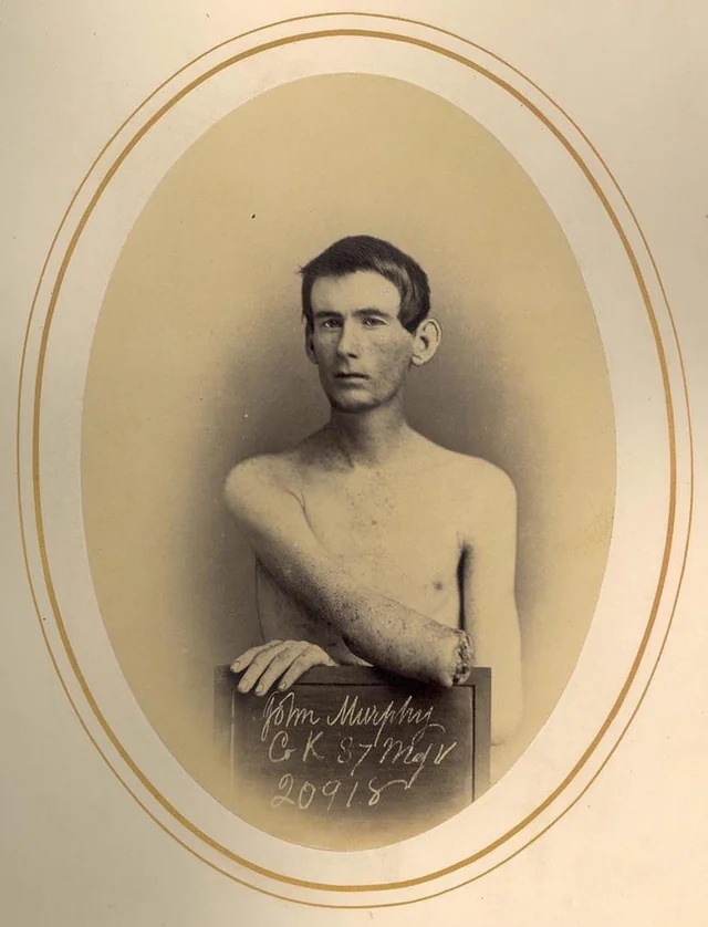 Surviving Limb Loss: The Stories of Civil War Amputee Veterans