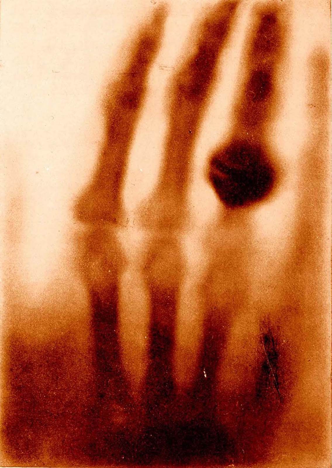 Hand Of Mrs. Wilhelm Röntgen, 1895