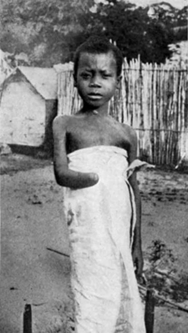 The Belgian Congo's Hacked Hands: A Brutal Reminder of Colonial Atrocities