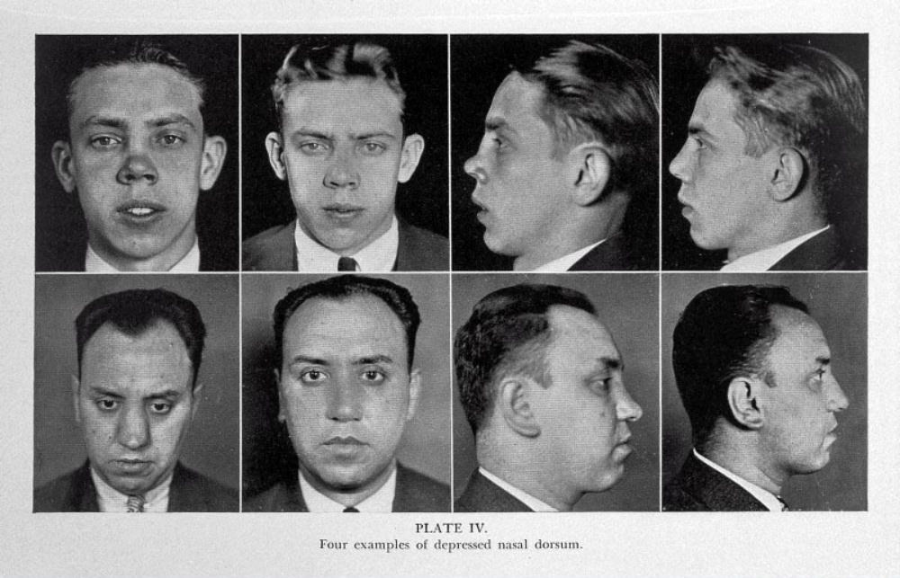 Nose Jobs Through the Ages: A Look at Rhinoplasty in the 1920s and 1930s