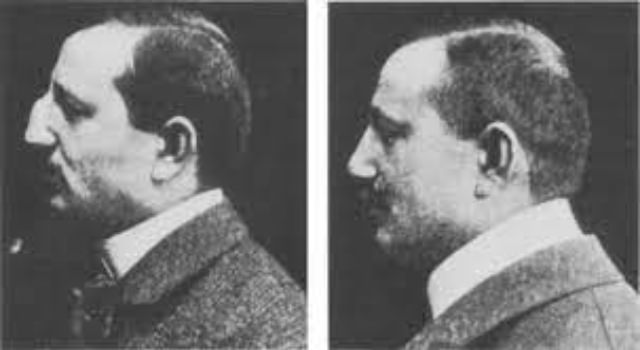 Nose Jobs Through the Ages: A Look at Rhinoplasty in the 1920s and 1930s