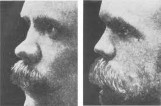 Nose Jobs Through the Ages: A Look at Rhinoplasty in the 1920s and 1930s
