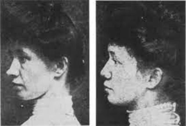 Nose Jobs Through the Ages: A Look at Rhinoplasty in the 1920s and 1930s