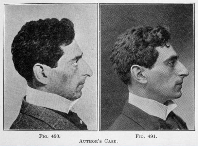 Nose Jobs Through the Ages: A Look at Rhinoplasty in the 1920s and 1930s