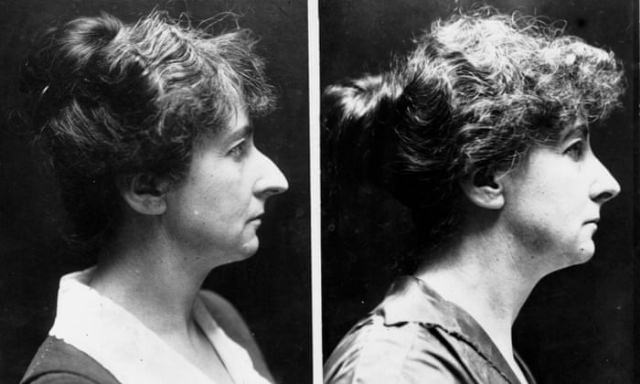 Nose Jobs Through the Ages: A Look at Rhinoplasty in the 1920s and 1930s