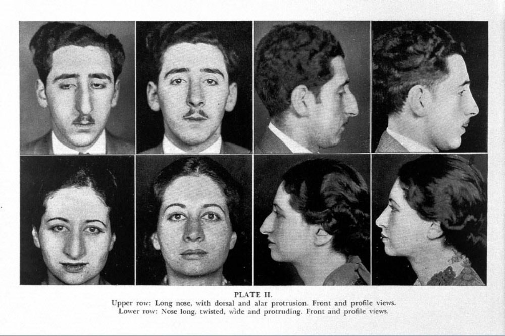 Nose Jobs Through the Ages: A Look at Rhinoplasty in the 1920s and 1930s