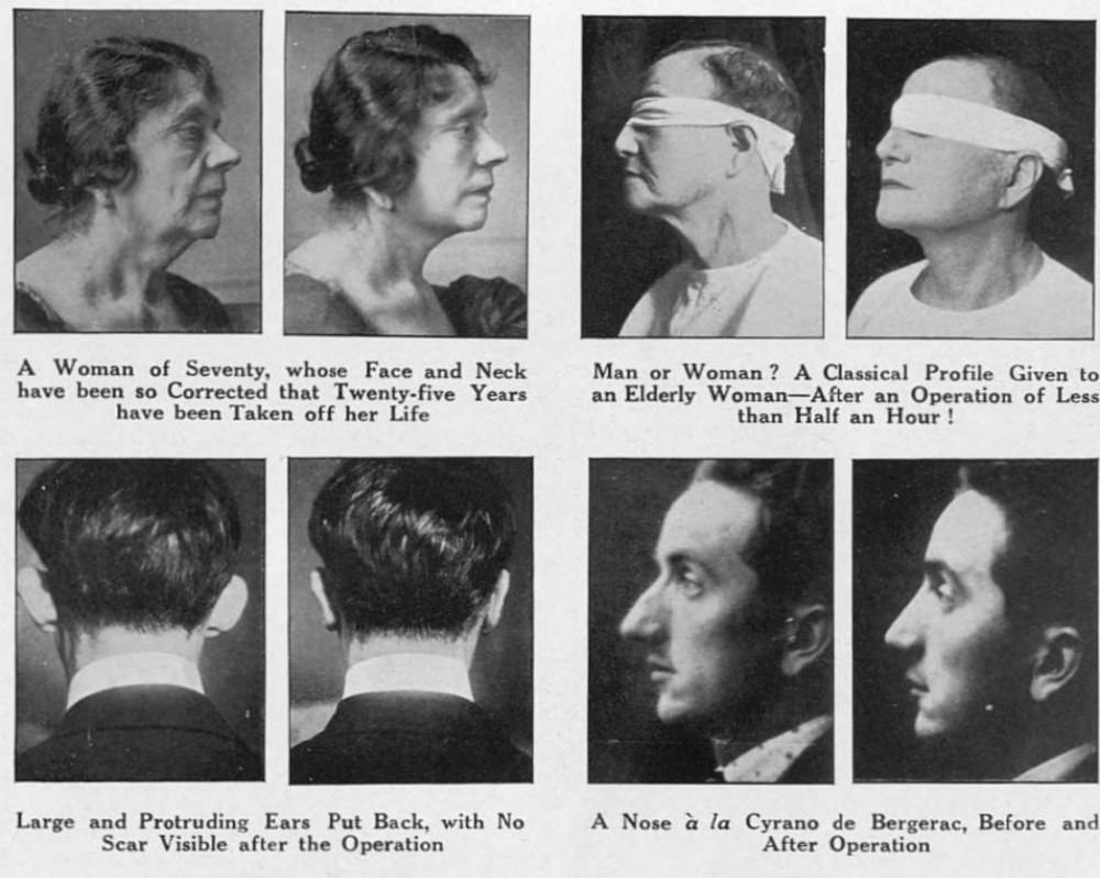 Nose Jobs Through the Ages: A Look at Rhinoplasty in the 1920s and 1930s