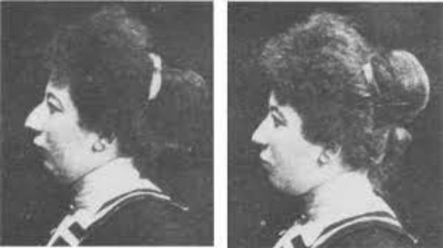 Nose Jobs Through the Ages: A Look at Rhinoplasty in the 1920s and 1930s