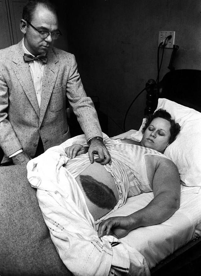 Ann Hodges, the Only Person Struck by a Meteorite, 1954