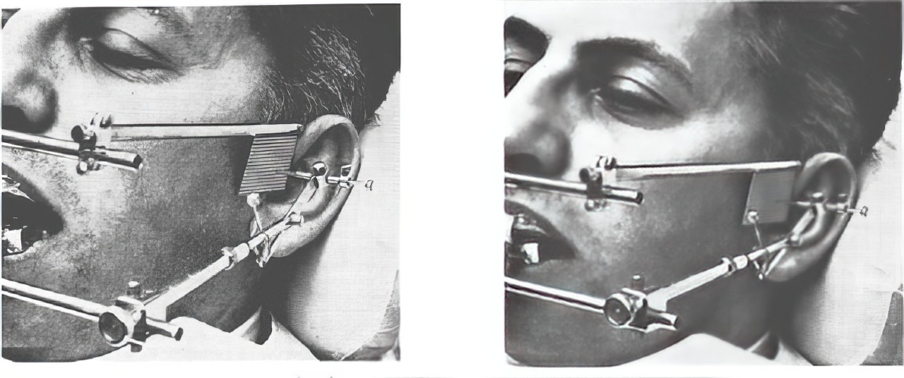 The Gnathograph: An Uncomfortable-Looking Device from the 1930s That Brought Precision to the Fit of Artificial Teeth