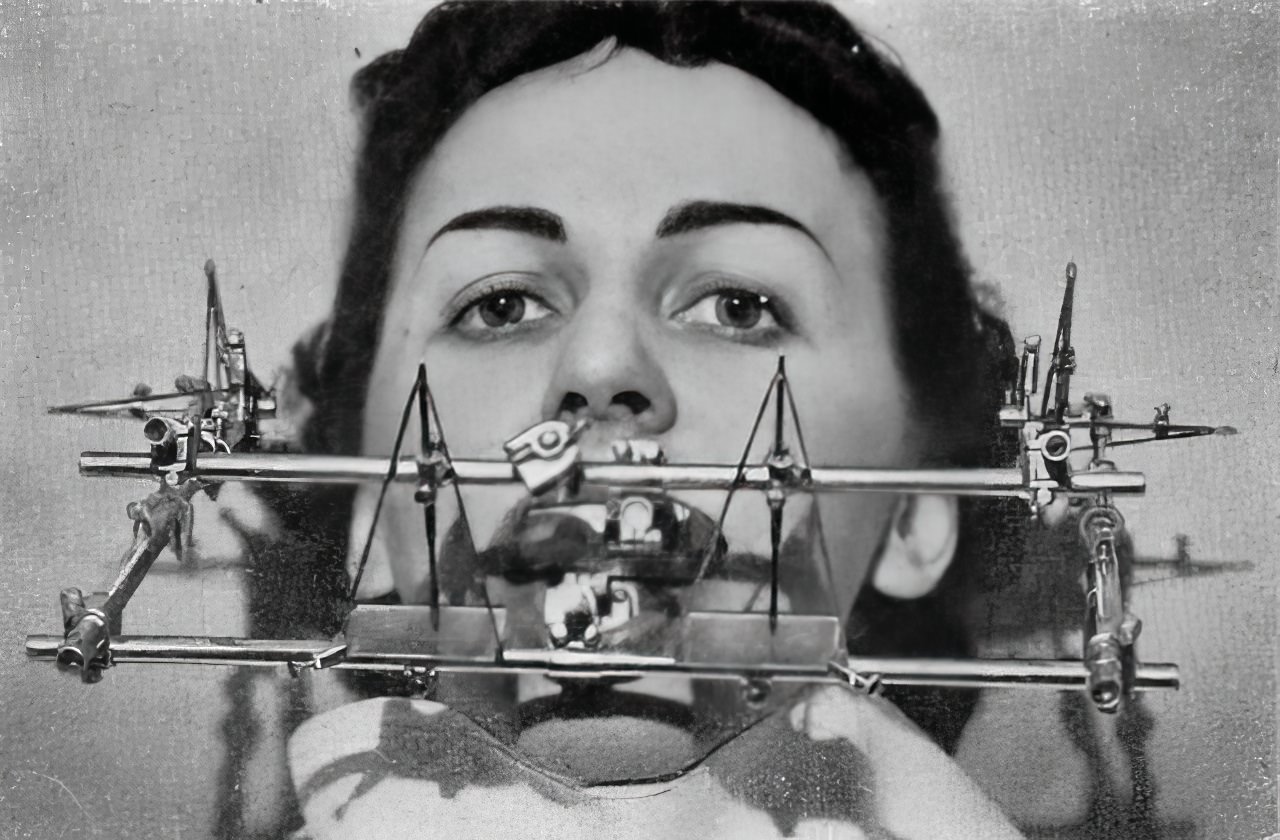 The Gnathograph: An Uncomfortable-Looking Device from the 1930s That Brought Precision to the Fit of Artificial Teeth
