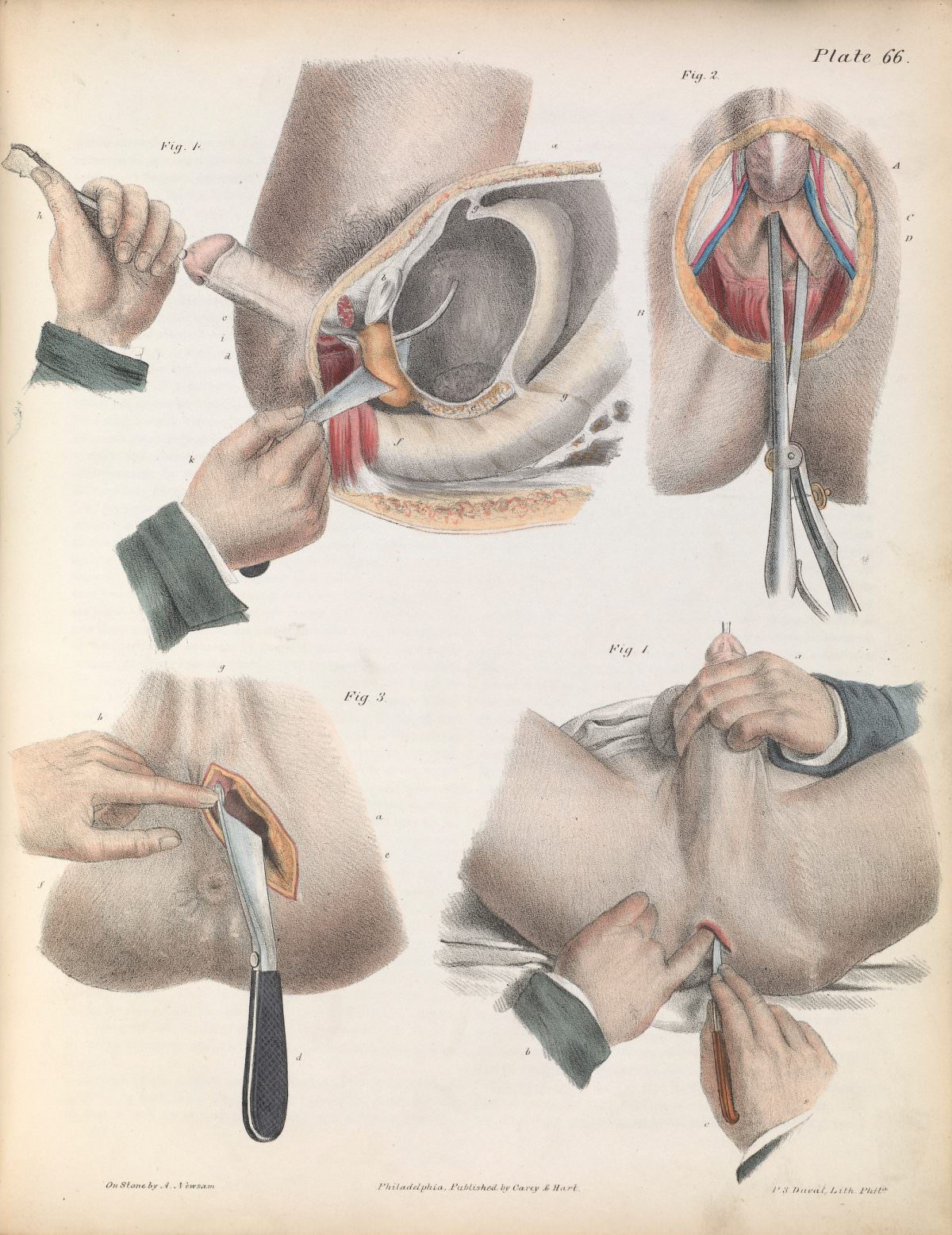Plate LXVI. Surgical technique for lithotomy.