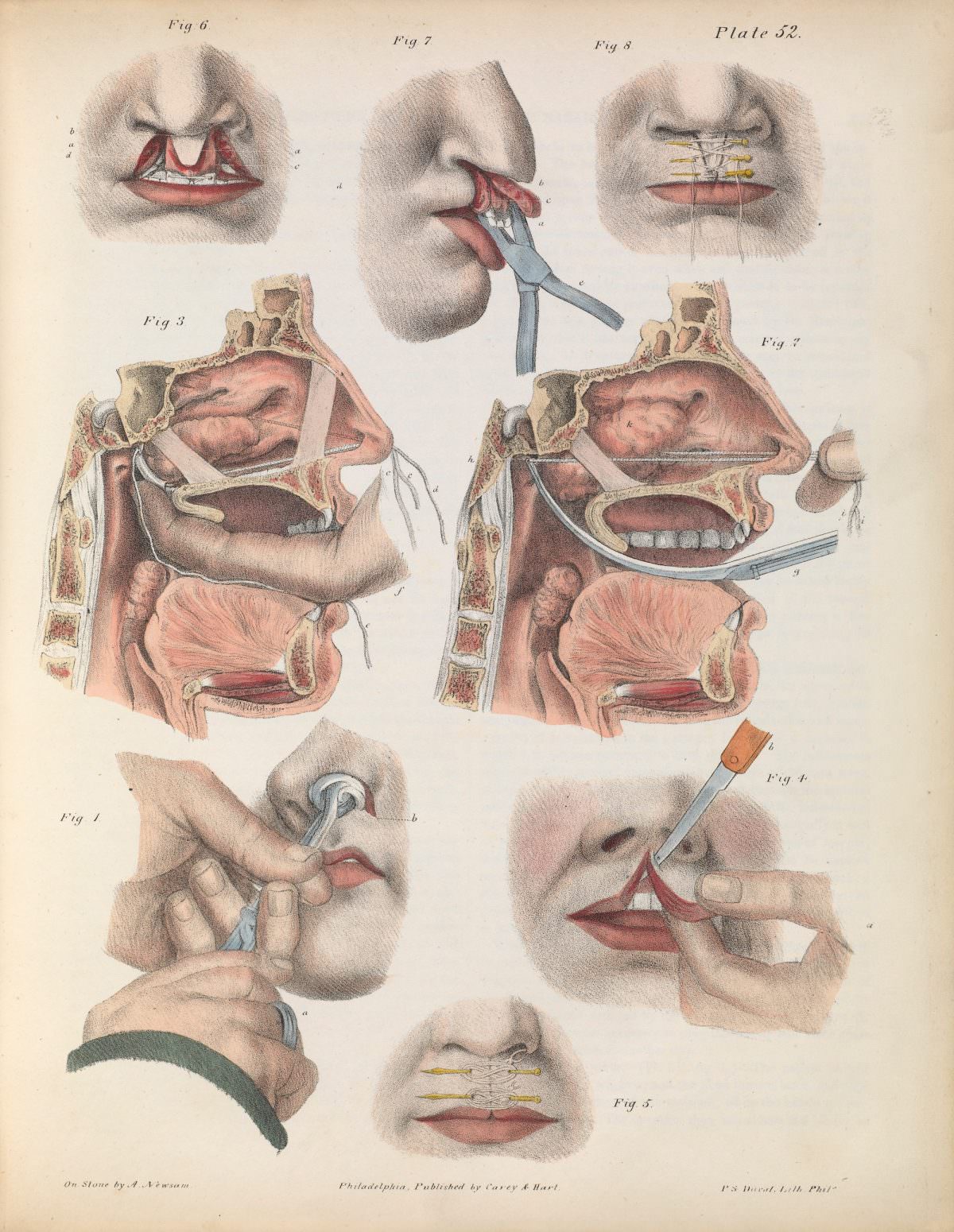 Fig. 1. Removal with the forceps by torsion and traction. Fig. 2, 3. Removal by ligature. Fig. 4,5. Simple hare-lip. Fig. 6, 7, 8. ‘Double hare-lip’ and ‘complicated hare-lip’.