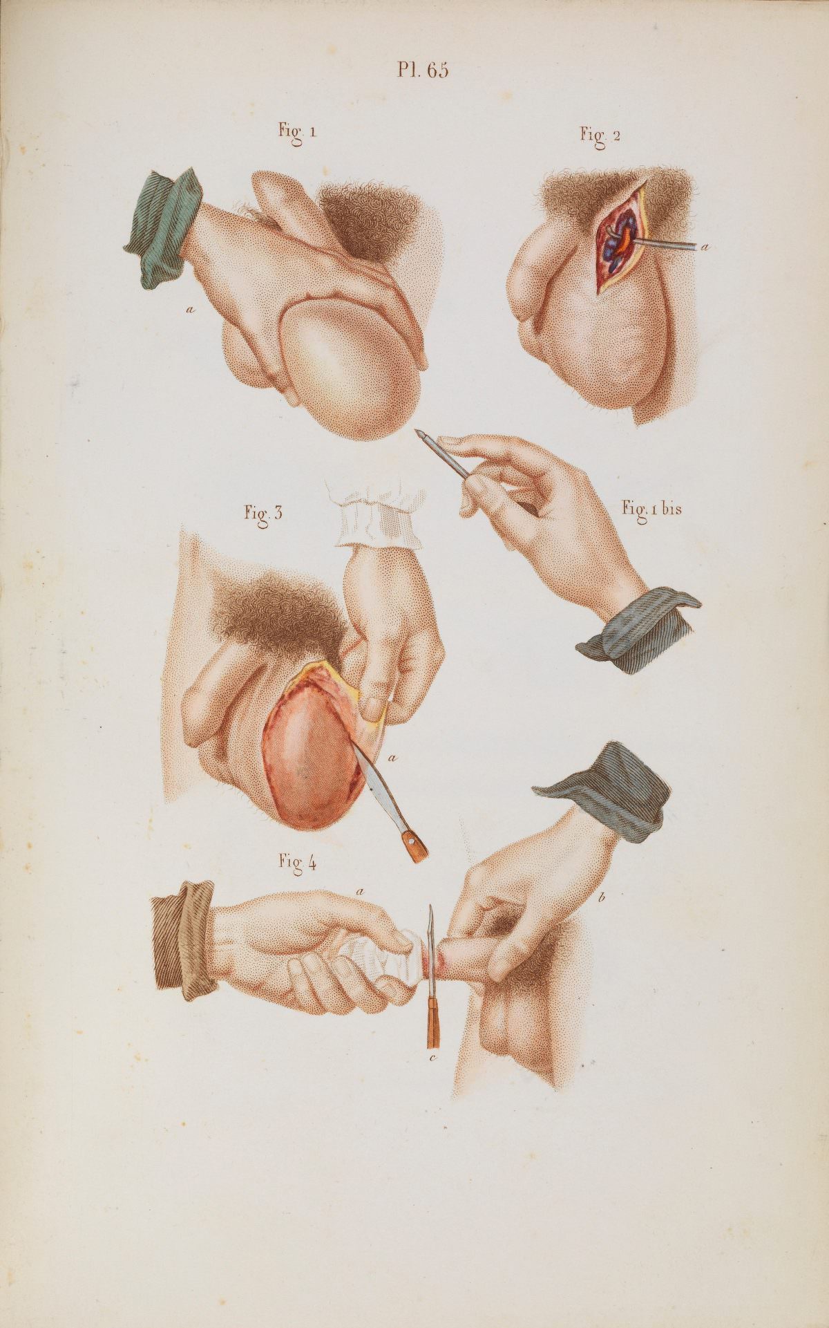 Plate 65, Surgical removal of tumours from the scrotum.