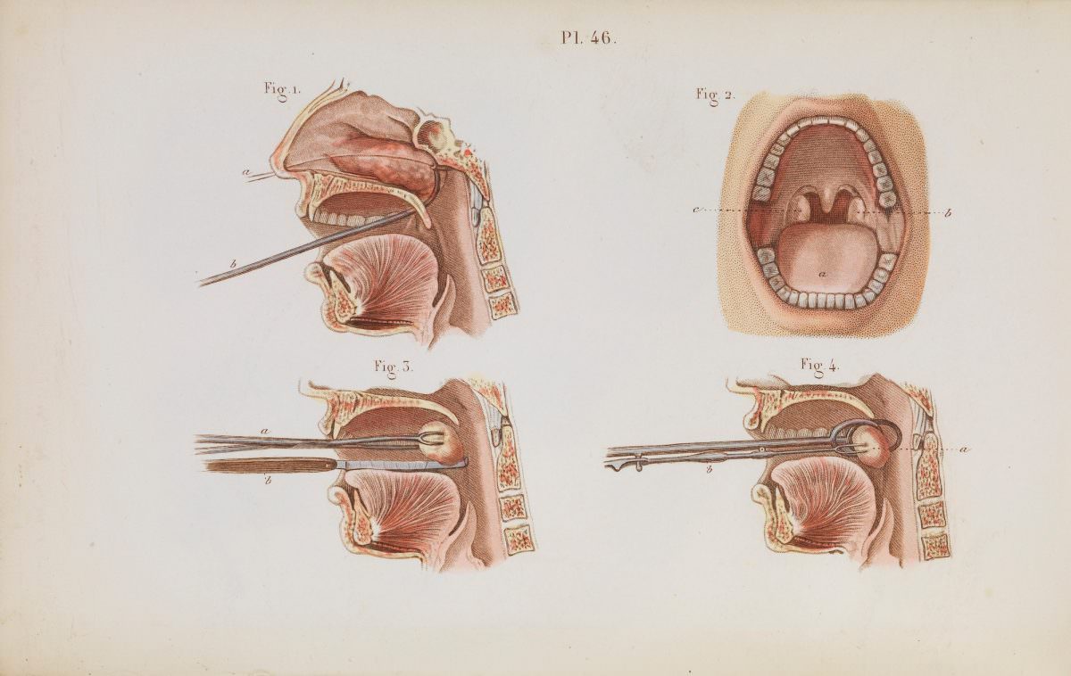Plate 46, Illustration of the removal of nasal polyps and tonsillectomy.