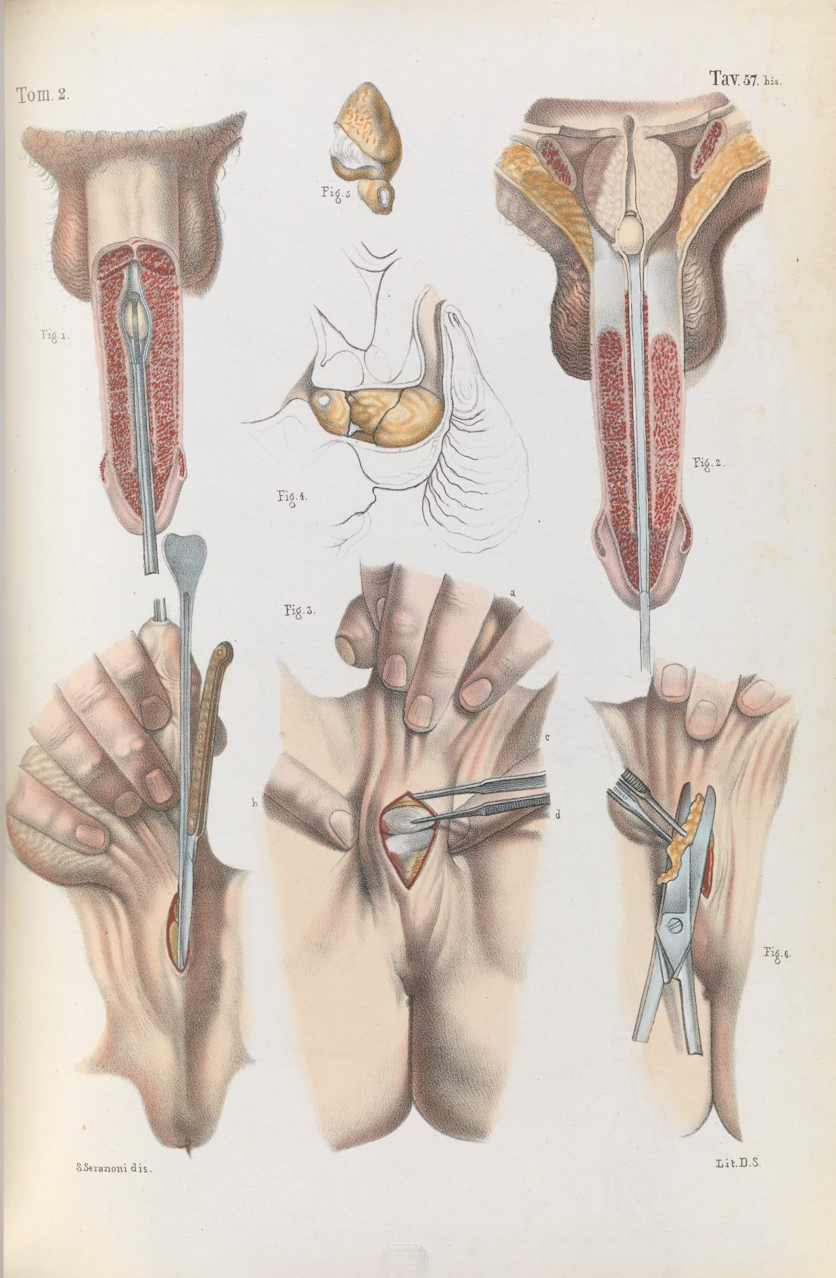 Tomo II, Tavola 57 bis. Procedure for the removal of stones from the prostate and urethra.