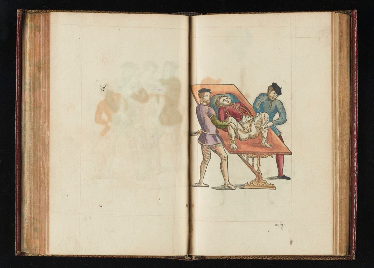 Hand painted wood engraving showing the necessary position for the patient for removal of bladder stones.
