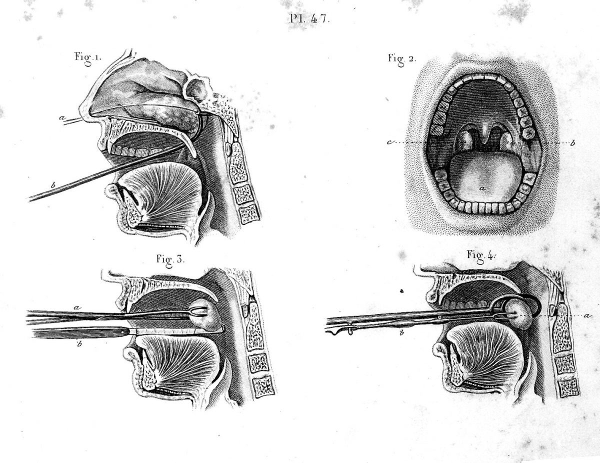 19th Century Illustrations for the Surgical Removal of Unwanted Parts of the Human Body