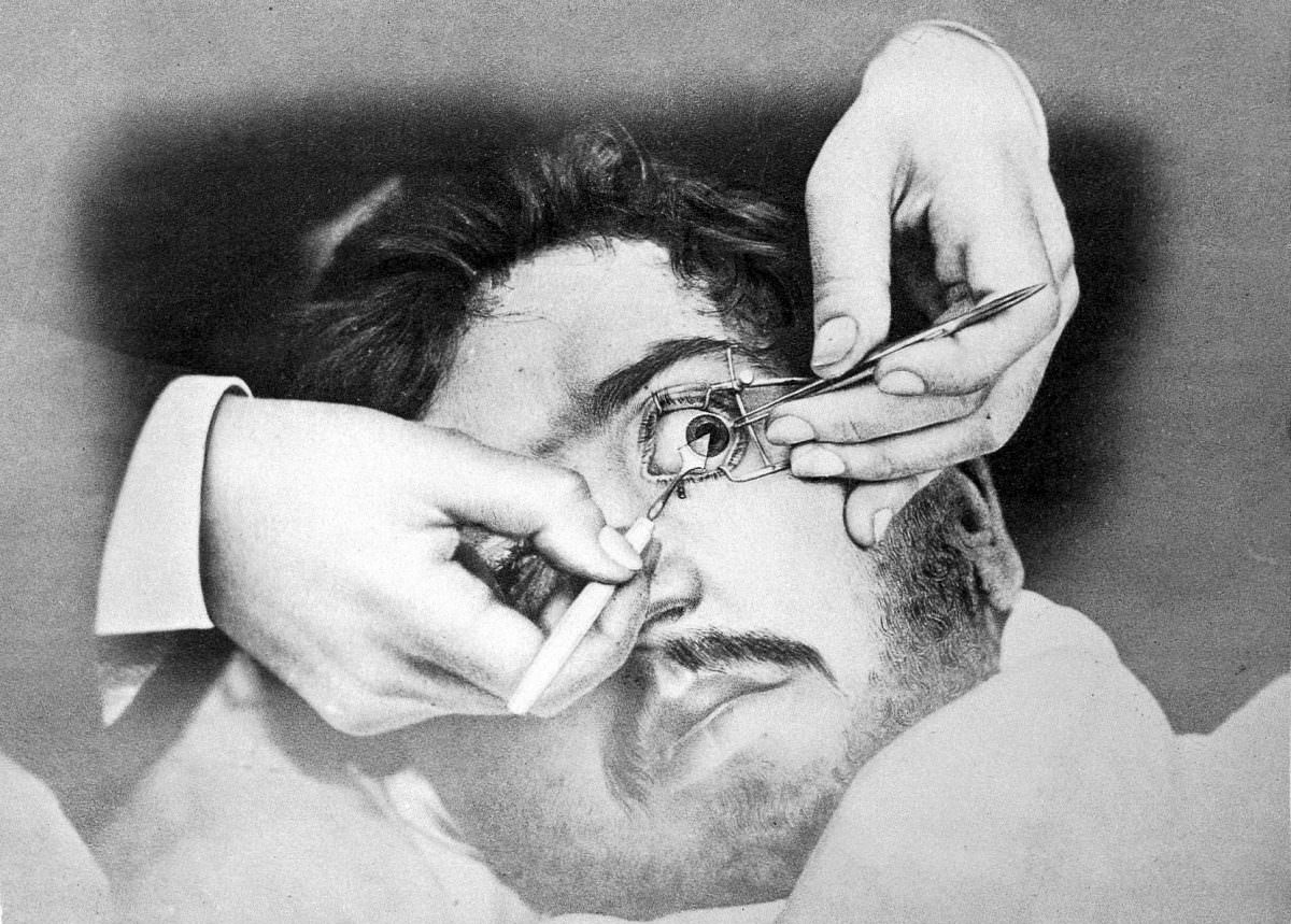 Surgery on the eye for the removal of a cataract.