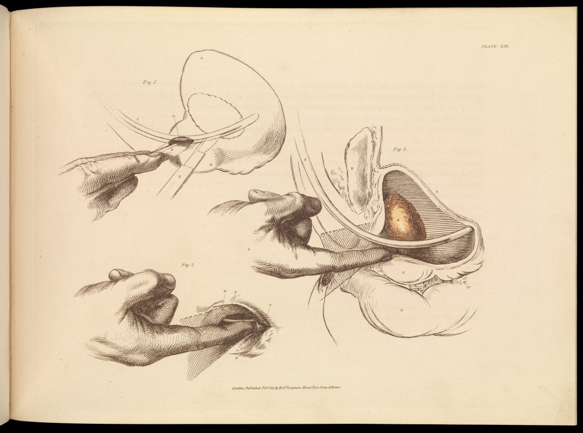 Plate XIX. Surgical removal of a stone from the bladder.