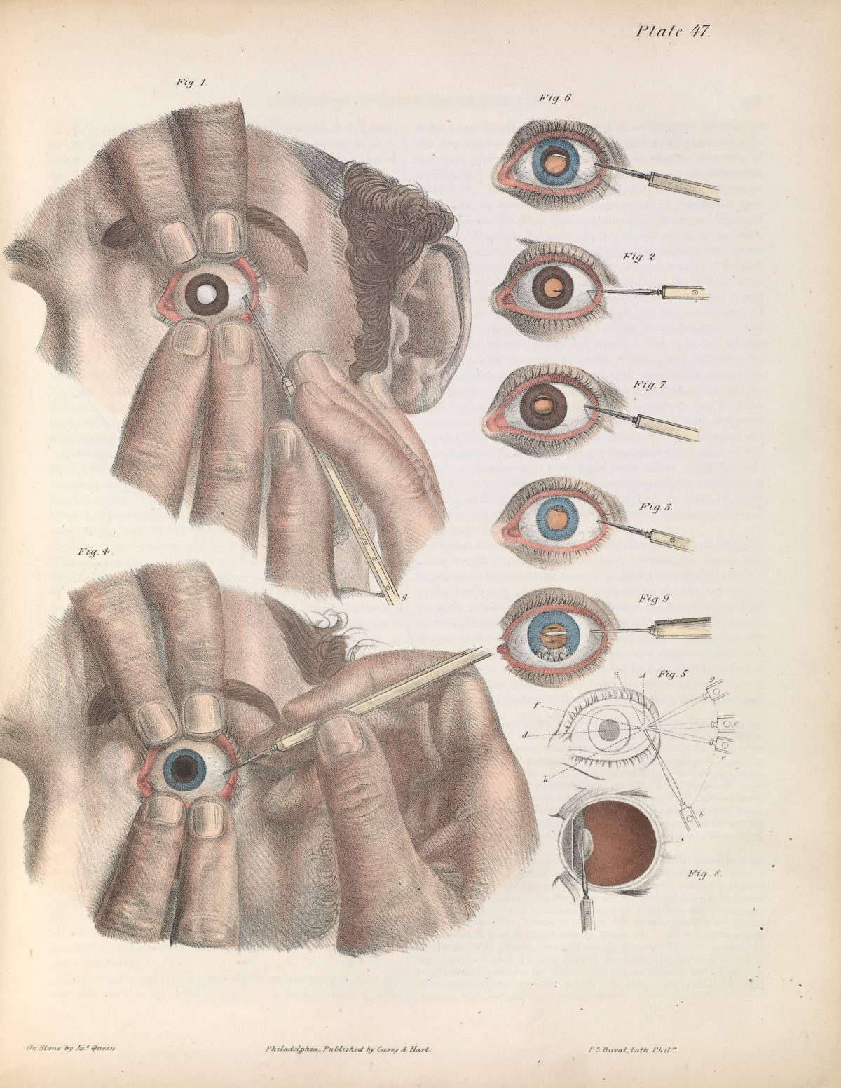 Removing cataracts