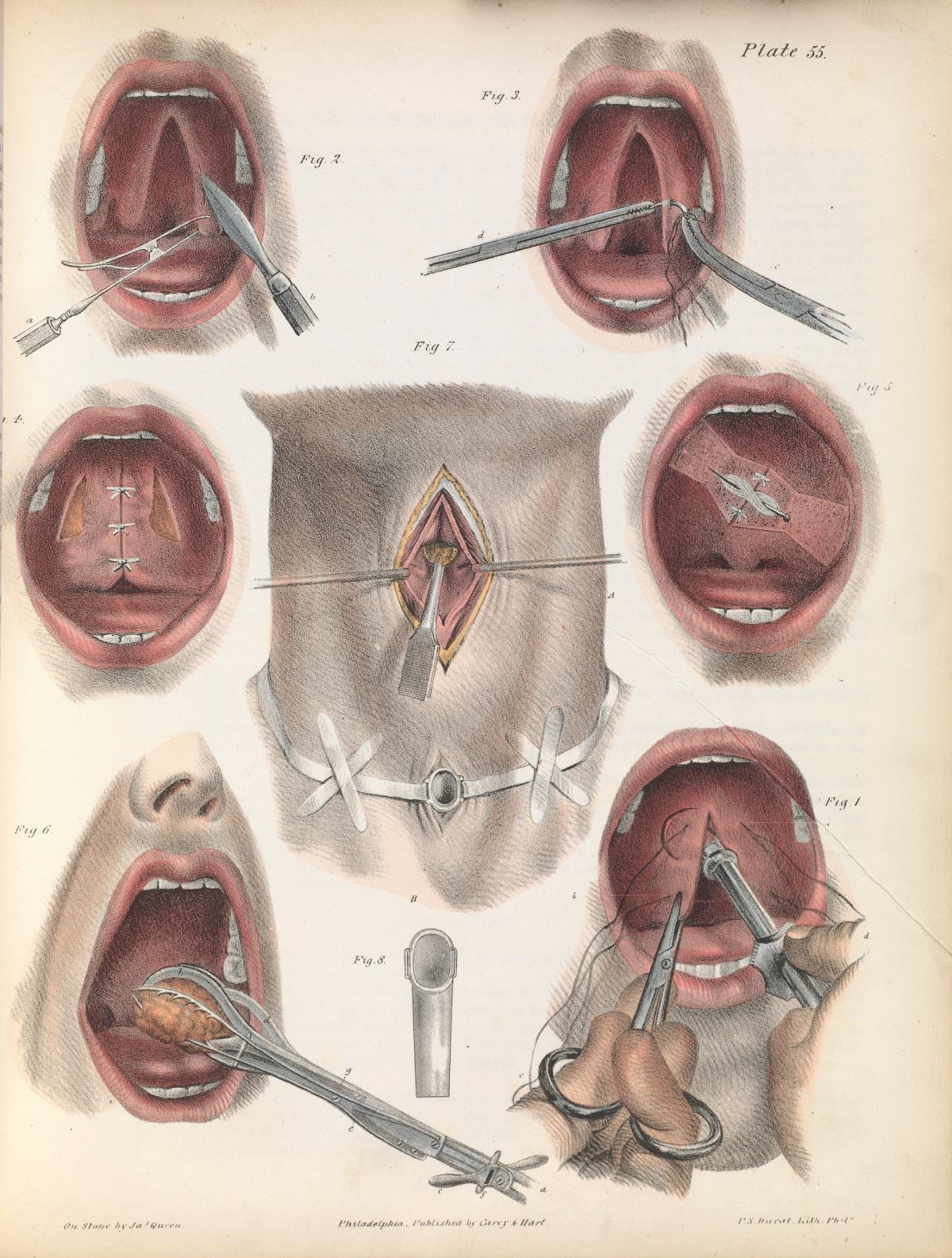 Plate 55, J. Pancoast, A treatise on operative surgery, 1846.