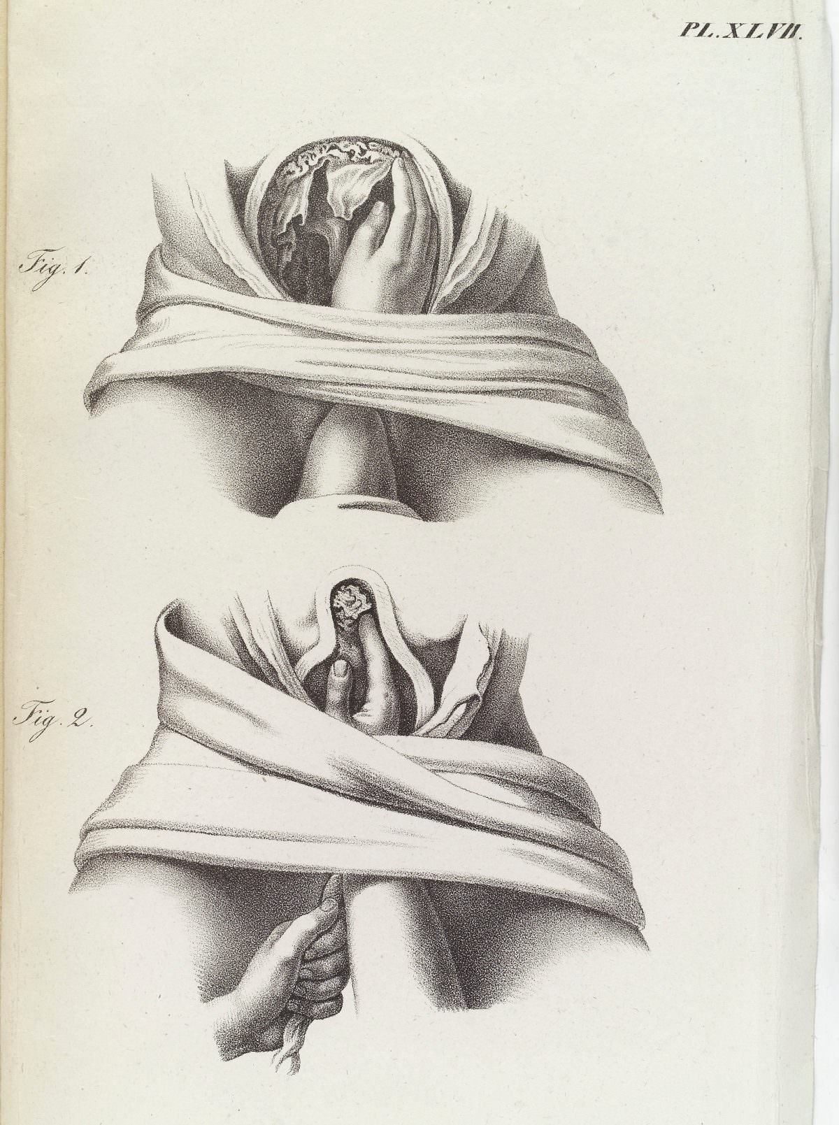 Removing the placenta and umbilical cord after birth. Abbildungen aus dem Gesammtgebiete der theoretisch-praktischen Geburtshülfe, nebst beschreibender Erklärung derselben / Nach dem Französischen des Maygrier bearbeitet und mit Anmerkungen versehen von Eduard Casp. Jac. von Siebold – 1829