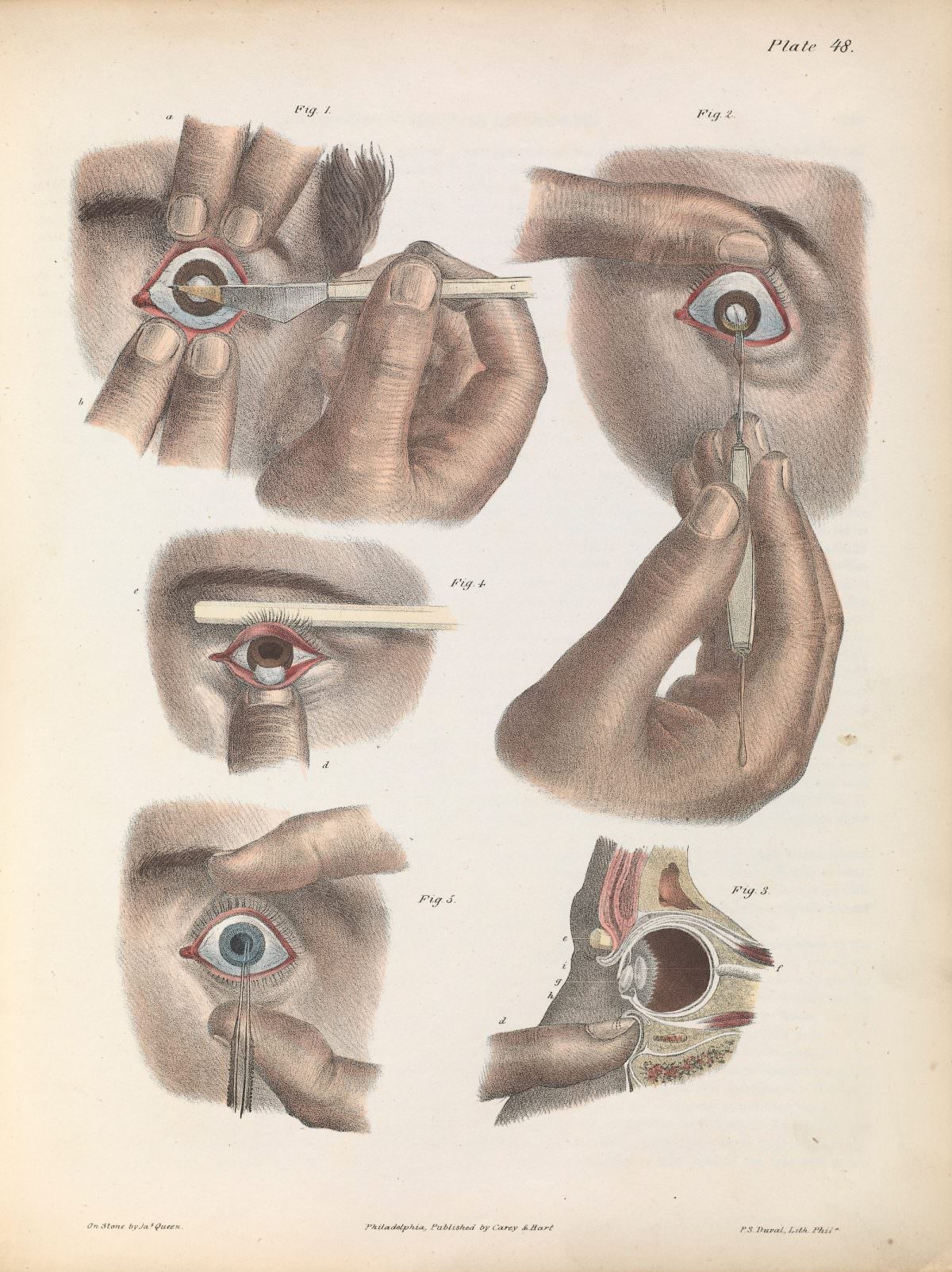 Plate XLVIII. Illustration of surgery on the eye for the removal of a cataract. Operation by extraction – inferior section of the cornea.