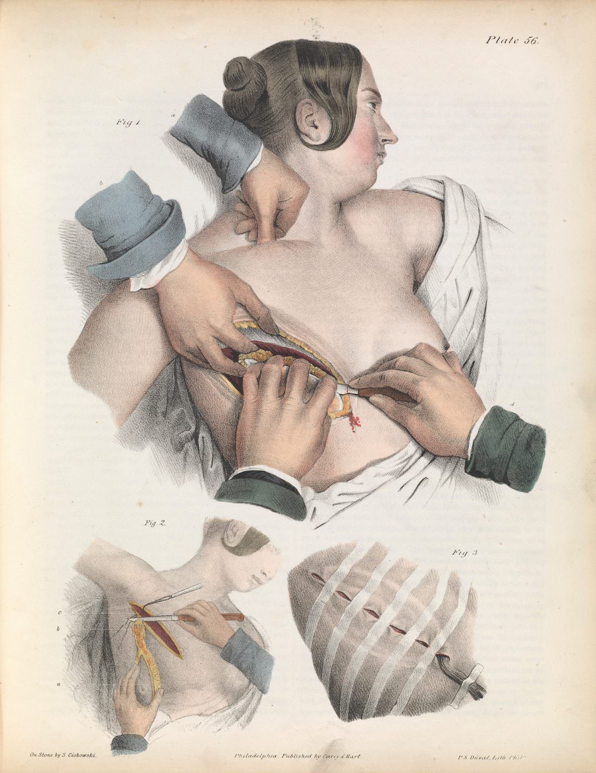 Plate LVI. Surgery for the removal of the mammary gland. 19th Century. Iconografia d’anatomia chirurgica e di medicina operatoria