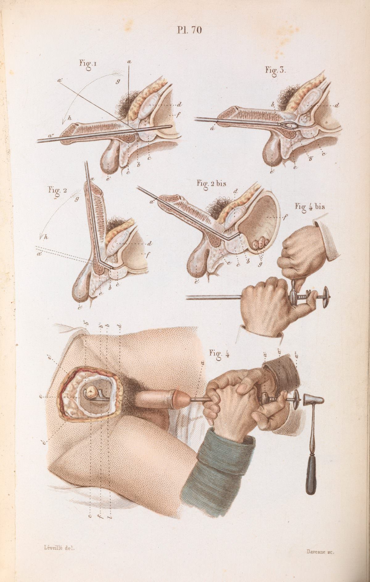 Plate 70, Surgical techniques for lithotripsy (the removal of bladder and kidney stones). Précis iconographique de médecine opératoire et d’anatomie chirurgicale by Claude Bernard (1848).
