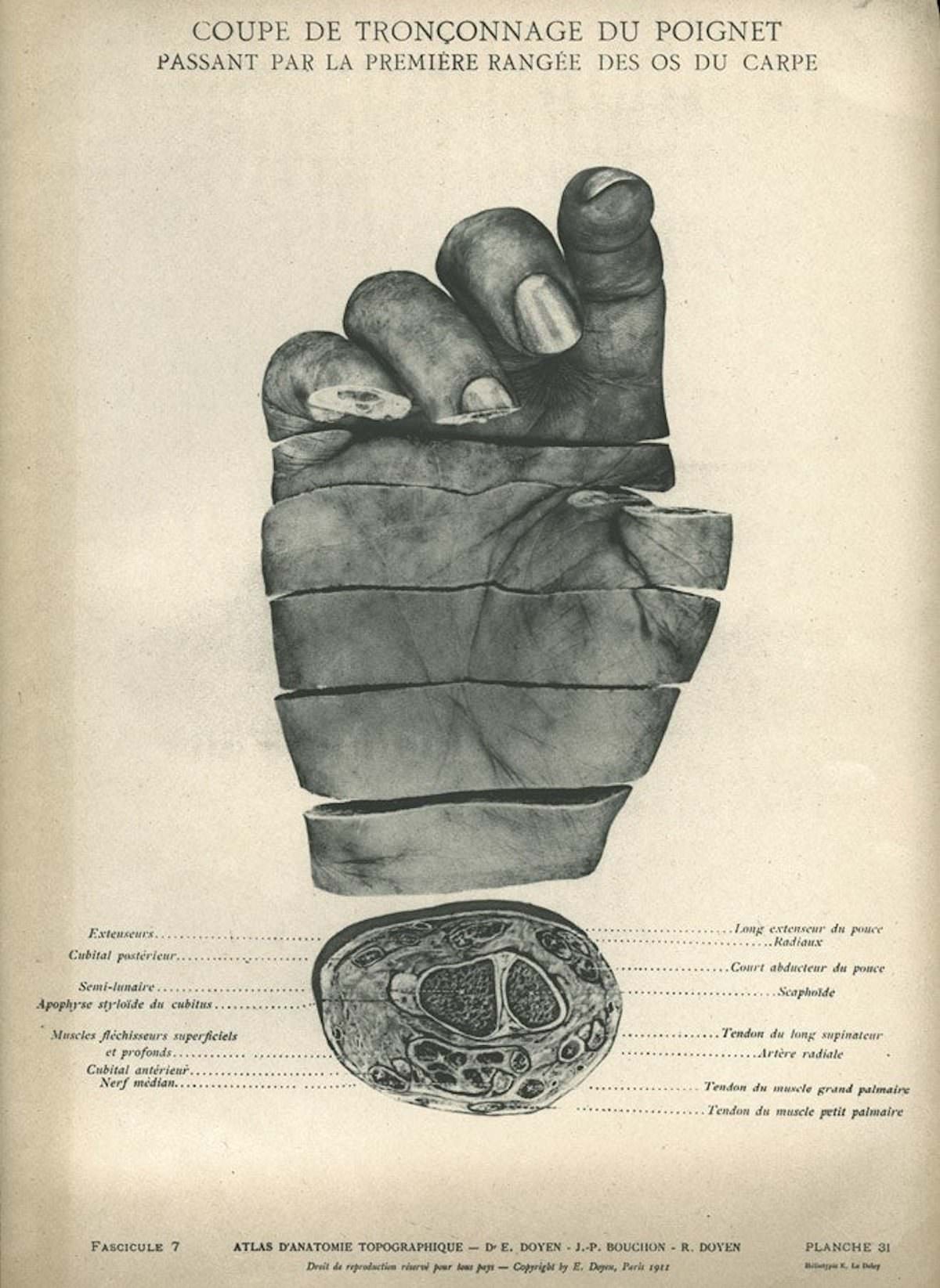Atlas of Topographic Anatomy (1911) by Eugène-Louis Doyen with J-P. Bouchon and R. Doyen