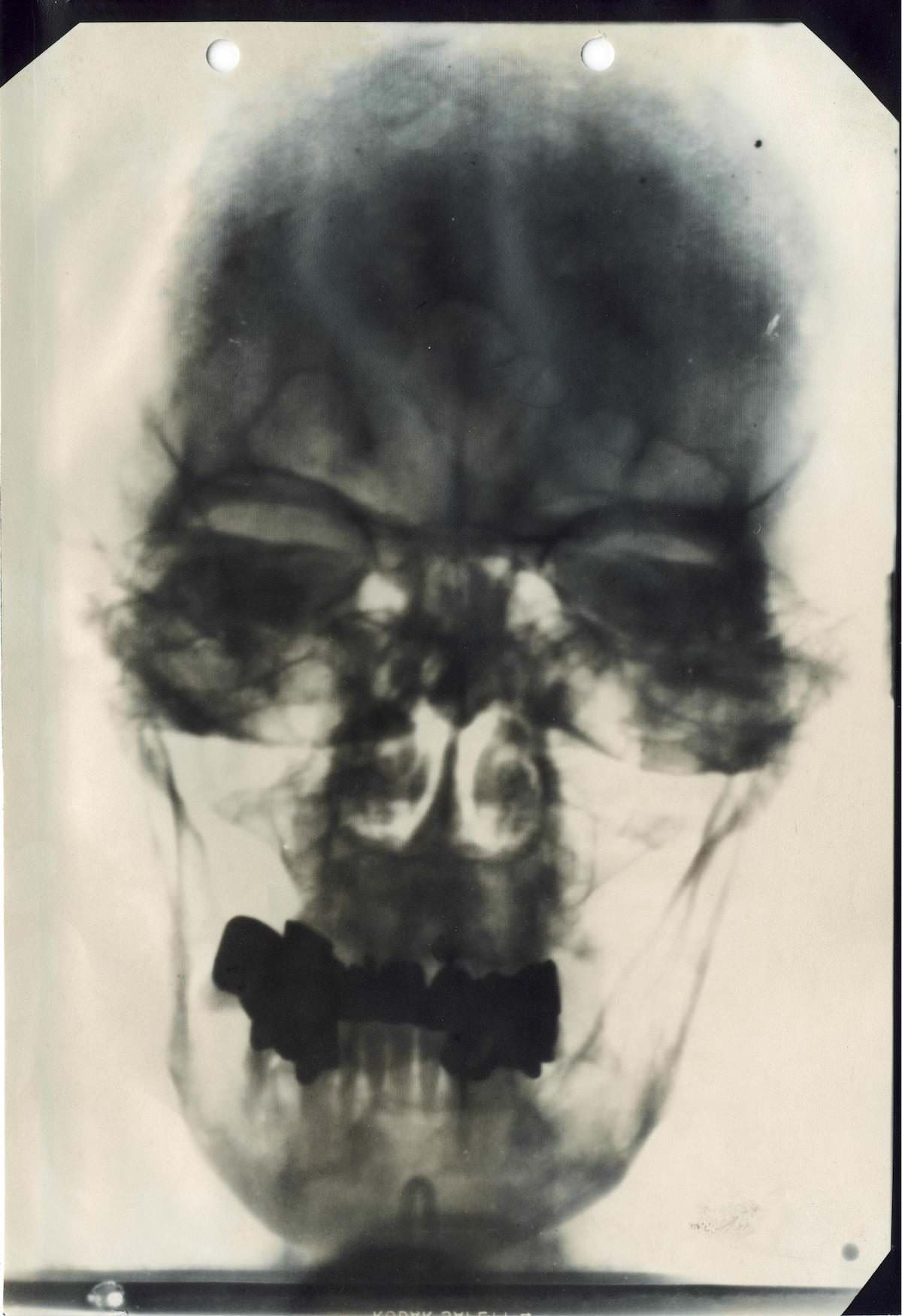 X-ray of Hitler’s nasal passages and teeth. Hitler as Seen by His Doctors