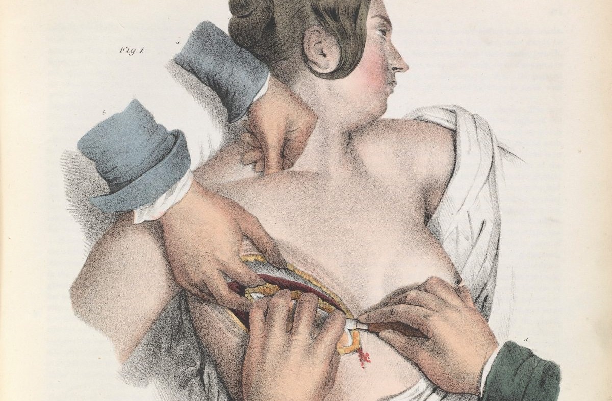 Surgical Removal illustrations