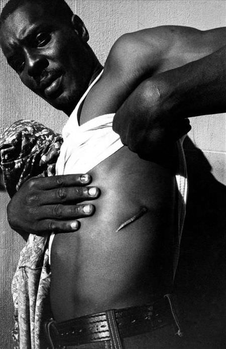 A small drug dealer shows one of his scars from multiple stab wounds, 1978.
