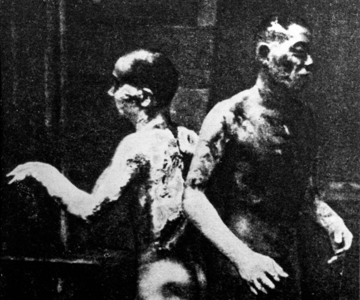 Two burn victims after the atomic explosion in Hiroshima, 1945
