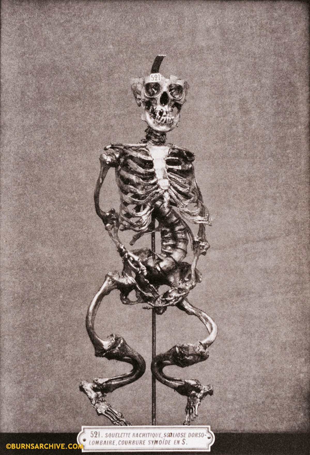 Deformed Skeleton Due to Rickets, 1879.