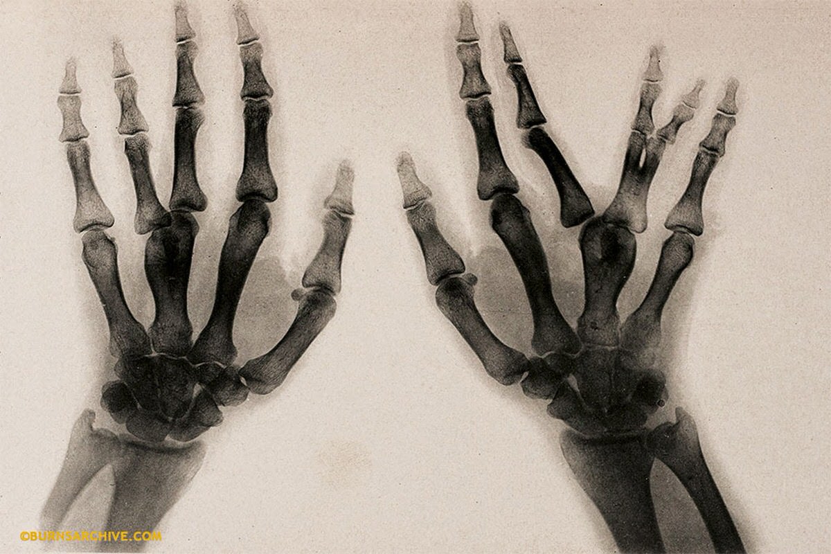 X-Ray of Deformity of Hand, Fused Metacarpal Bones, 1907.